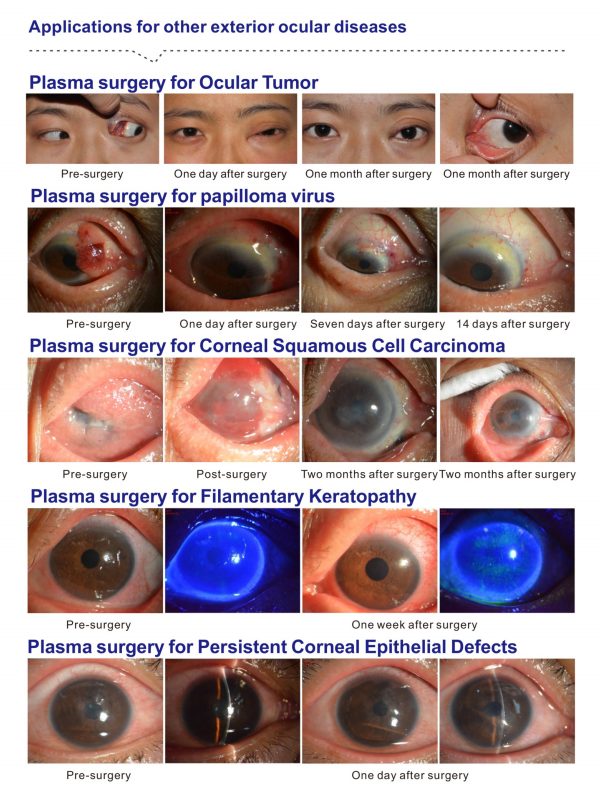 Pterygium Resection Eye Probe