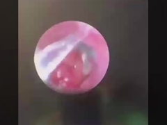 ButterFly ENT Surgery Instruments ENT Probe