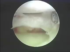 Electrosurgical Instruments Ablation Systems Ablation Products For Spine And Joints