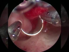 Cool Technology Plasma Surgery Electrode For Urology BPH Procedures